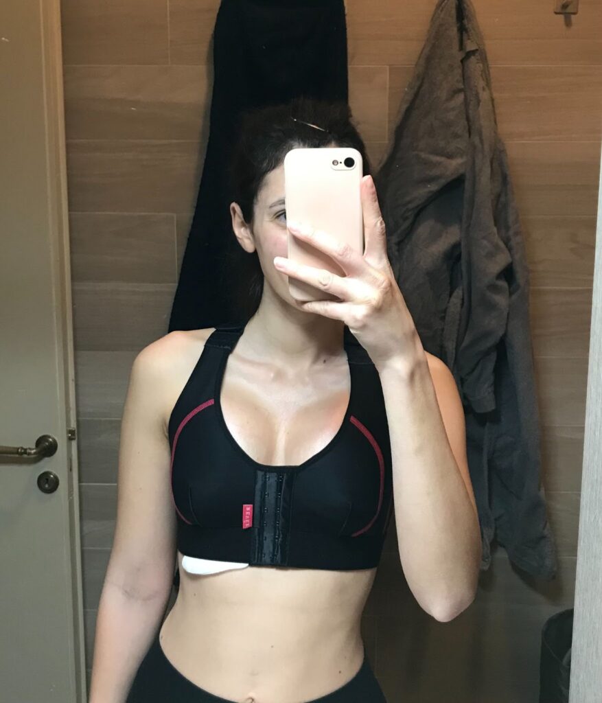 visione frontale post operazione con la dottoressa Marzia Moio