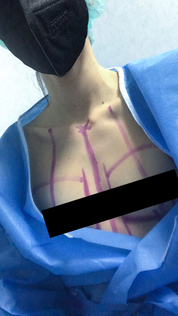 io con i segni sul petto per l'operazione