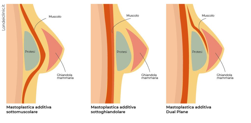 differenze del posizionamento della protesi