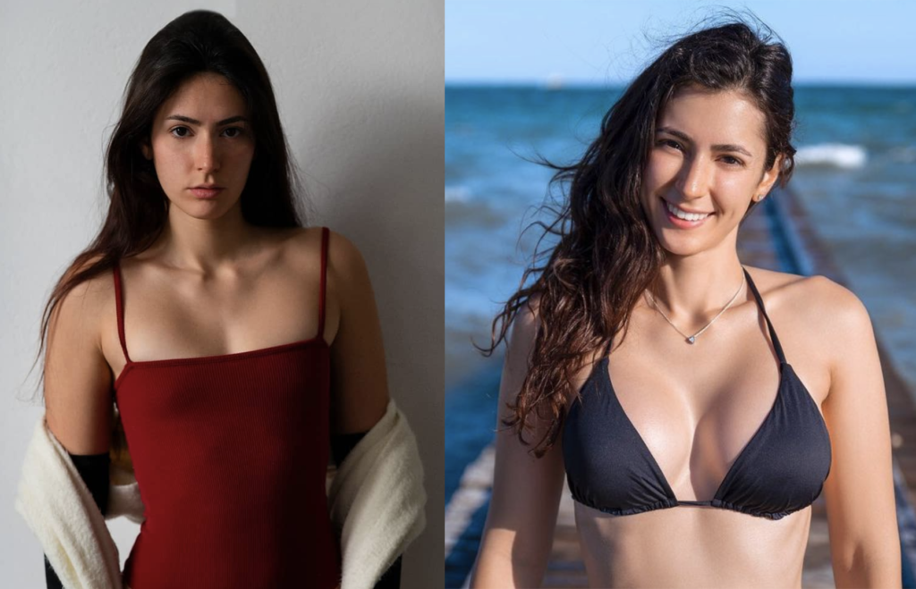 Mastoplastica additiva: la mia esperienza